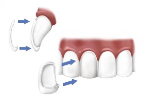 faccette dentali applicazione