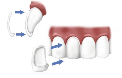 faccette dentali applicazione