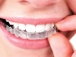 trattamento invisalign