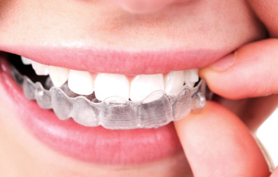 trattamento invisalign