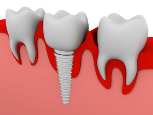 denti fissi