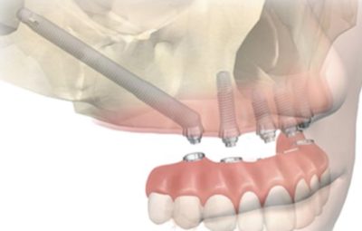 brescia implantologia zigomatica sfp